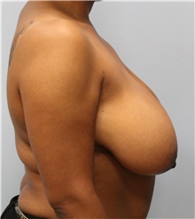 Breast Reduction Before Photo by Hampton Howell, MD; Winston-Salem, NC - Case 40720
