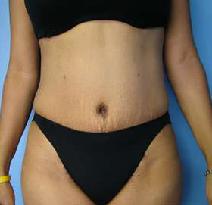 Tummy Tuck After Photo by Fadi Chahin, MD, FACS; Beverly Hills, CA - Case 8427