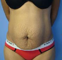 Tummy Tuck Before Photo by Fadi Chahin, MD, FACS; Beverly Hills, CA - Case 8427