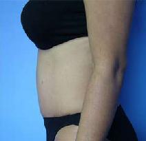 Tummy Tuck After Photo by Fadi Chahin, MD, FACS; Beverly Hills, CA - Case 8427