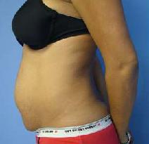 Tummy Tuck Before Photo by Fadi Chahin, MD, FACS; Beverly Hills, CA - Case 8427