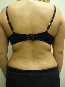 Liposuction Before Photo by Fadi Chahin, MD, FACS; Beverly Hills, CA - Case 8471