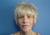 Facelift Before Photo by Fadi Chahin, MD, FACS; Beverly Hills, CA - Case 8590