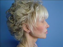 Facelift After Photo by Fadi Chahin, MD, FACS; Beverly Hills, CA - Case 8590