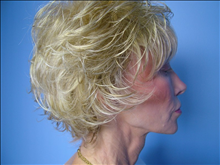 Facelift Before Photo by Fadi Chahin, MD, FACS; Beverly Hills, CA - Case 8590