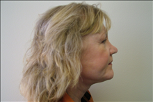 Facelift After Photo by Fadi Chahin, MD, FACS; Beverly Hills, CA - Case 8661