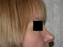 Rhinoplasty After Photo by Mohamad Bazzi, MD; Canton, MI - Case 20326