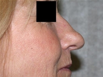 Rhinoplasty Before Photo by Mohamad Bazzi, MD; Canton, MI - Case 20326