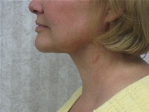 Facelift After Photo by Mohamad Bazzi, MD; Canton, MI - Case 20730