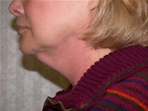 Facelift Before Photo by Mohamad Bazzi, MD; Canton, MI - Case 20730