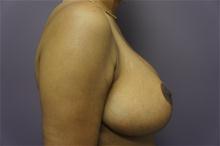 Breast Reduction After Photo by Kevin Tehrani, MD; Great Neck, NY - Case 26656