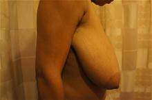 Breast Reduction Before Photo by Kevin Tehrani, MD; Great Neck, NY - Case 26656