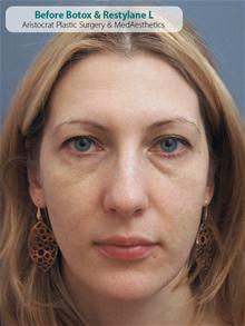 Botulinum Toxin Before Photo by Kevin Tehrani, MD; Great Neck, NY - Case 26828