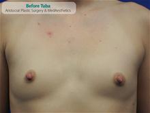 Breast Augmentation Before Photo by Kevin Tehrani, MD; Great Neck, NY - Case 27219