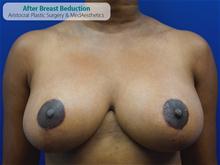 Breast Reduction After Photo by Kevin Tehrani, MD; Great Neck, NY - Case 27227