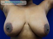 Breast Reduction Before Photo by Kevin Tehrani, MD; Great Neck, NY - Case 27227