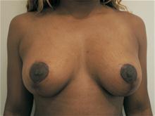 Breast Lift After Photo by Kevin Tehrani, MD; Great Neck, NY - Case 27848