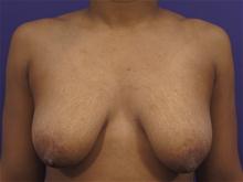 Breast Lift Before Photo by Kevin Tehrani, MD; Great Neck, NY - Case 27848