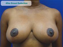 Breast Reduction After Photo by Kevin Tehrani, MD; Great Neck, NY - Case 27852