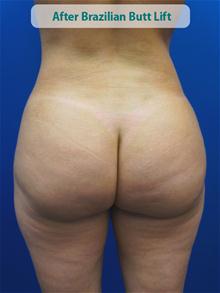 Body Contouring After Photo by Kevin Tehrani, MD; Great Neck, NY - Case 27859