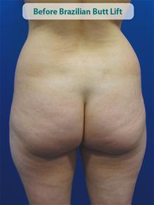 Body Contouring Before Photo by Kevin Tehrani, MD; Great Neck, NY - Case 27859