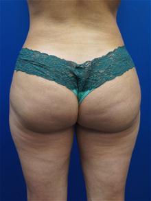 Liposuction After Photo by Kevin Tehrani, MD; Great Neck, NY - Case 27911