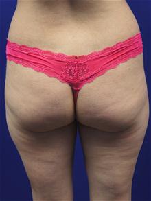 Liposuction Before Photo by Kevin Tehrani, MD; Great Neck, NY - Case 27911
