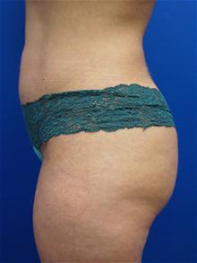 Liposuction After Photo by Kevin Tehrani, MD; Great Neck, NY - Case 27911