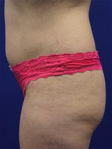 Liposuction Before Photo by Kevin Tehrani, MD; Great Neck, NY - Case 27911