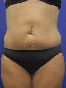 Tummy Tuck Before Photo by Kevin Tehrani, MD; Great Neck, NY - Case 27914