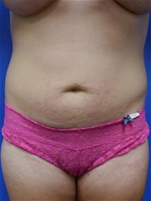 Liposuction Before Photo by Kevin Tehrani, MD; Great Neck, NY - Case 27925