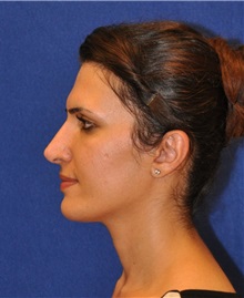 Rhinoplasty After Photo by Ali Sajjadian, M.D., F.A.C.S.; Newport Beach, CA - Case 33083