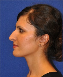 Rhinoplasty Before Photo by Ali Sajjadian, M.D., F.A.C.S.; Newport Beach, CA - Case 33083