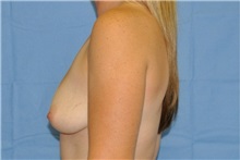 Breast Augmentation Before Photo by Ali Sajjadian, M.D., F.A.C.S.; Newport Beach, CA - Case 33091