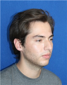 Rhinoplasty Before Photo by Ali Sajjadian, M.D., F.A.C.S.; Newport Beach, CA - Case 44189