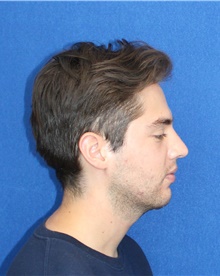 Rhinoplasty After Photo by Ali Sajjadian, M.D., F.A.C.S.; Newport Beach, CA - Case 44189