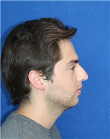 Rhinoplasty Before Photo by Ali Sajjadian, M.D., F.A.C.S.; Newport Beach, CA - Case 44189