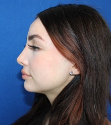 Rhinoplasty After Photo by Ali Sajjadian, M.D., F.A.C.S.; Newport Beach, CA - Case 44210