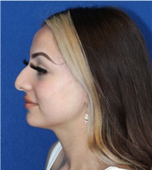 Rhinoplasty Before Photo by Ali Sajjadian, M.D., F.A.C.S.; Newport Beach, CA - Case 44210