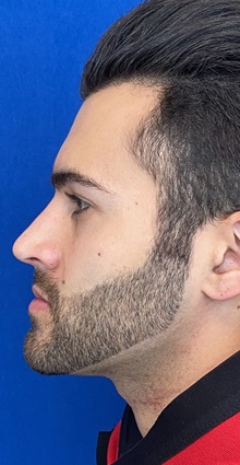 Rhinoplasty After Photo by Ali Sajjadian, M.D., F.A.C.S.; Newport Beach, CA - Case 44214