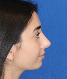 Rhinoplasty After Photo by Ali Sajjadian, M.D., F.A.C.S.; Newport Beach, CA - Case 44215