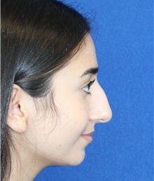 Rhinoplasty Before Photo by Ali Sajjadian, M.D., F.A.C.S.; Newport Beach, CA - Case 44215