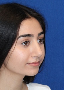 Rhinoplasty After Photo by Ali Sajjadian, M.D., F.A.C.S.; Newport Beach, CA - Case 44215