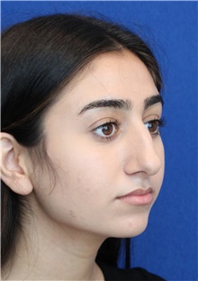 Rhinoplasty Before Photo by Ali Sajjadian, M.D., F.A.C.S.; Newport Beach, CA - Case 44215