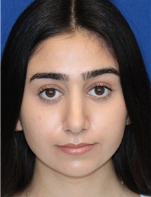 Rhinoplasty After Photo by Ali Sajjadian, M.D., F.A.C.S.; Newport Beach, CA - Case 44215