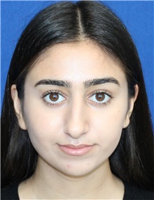 Rhinoplasty Before Photo by Ali Sajjadian, M.D., F.A.C.S.; Newport Beach, CA - Case 44215