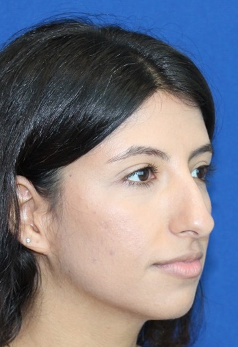 Overweight and Breast Reduction Surgery - Ali Sajjadian, MD