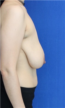 Breast Reduction Before Photo by Ali Sajjadian, M.D., F.A.C.S.; Newport Beach, CA - Case 44218