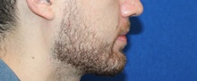 Chin Augmentation After Photo by Ali Sajjadian, M.D., F.A.C.S.; Newport Beach, CA - Case 44219