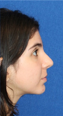 Rhinoplasty After Photo by Ali Sajjadian, M.D., F.A.C.S.; Newport Beach, CA - Case 44223